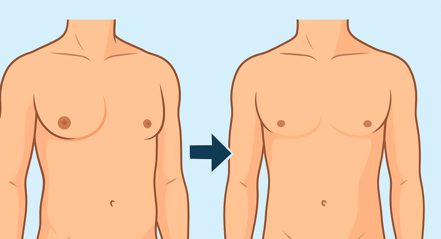 علاج التثدي عند الرجال – دليل شامل لحلول التثدي