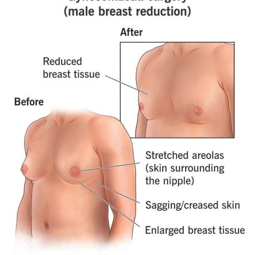 24022-gynecomastia-male-reduction-surgery
